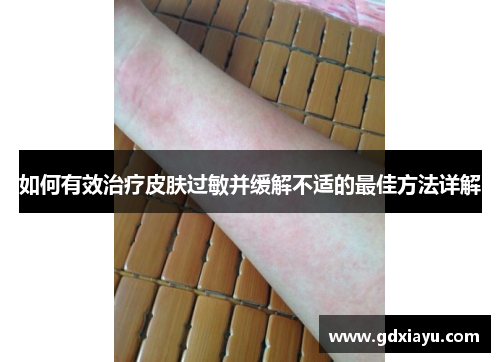 如何有效治疗皮肤过敏并缓解不适的最佳方法详解 如何有效治疗皮肤过敏并缓解不适的最佳方法详解